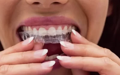 Invisalign Anaheim: Clear Aligner Therapy for Discreet Orthodontic Correction